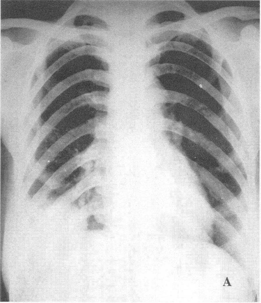 (图) 混合型肺癌